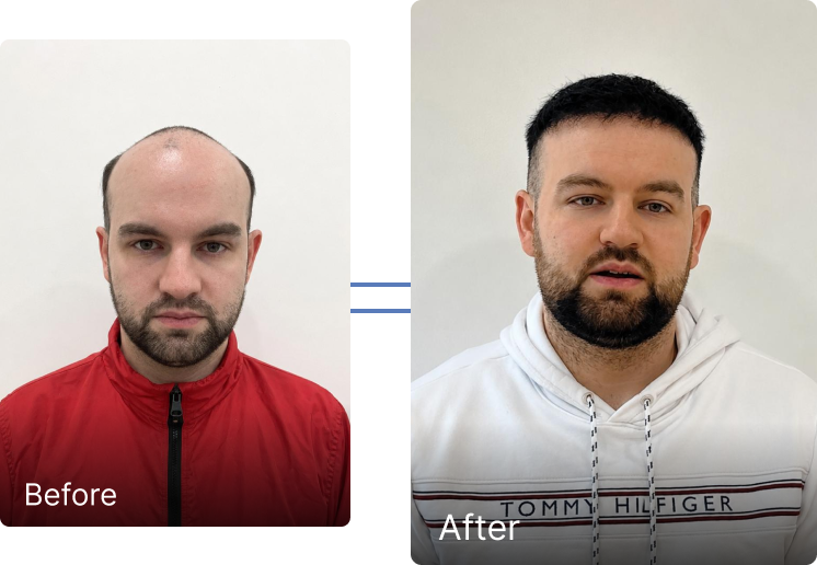 Before and after result 4